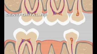 Лечение деформации зубного ряда с помощью брекетов