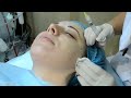Фрагмент с середины видео Биоревитализация лица гиалуроновой кислотой, уколы красоты, до и после - понятная косметология Фрагмент с середины видео Биоревитализация лица гиалуроновой кислотой, уколы красоты, до и после - понятная косметология