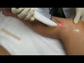 Video: Spider Veins Laser treatment-Fotona Nd: Yag Laser-Valley Aesthetics & Laser