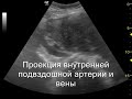 Нажмите для просмотра : Гигантская фибромиома матки!