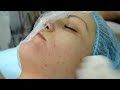Фрагмент с середины видео Мезотерапия лица, вылечить акне, избавиться от прыщей - понятная косметология #13 Фрагмент с середины видео Мезотерапия лица, вылечить акне, избавиться от прыщей - понятная косметология #13