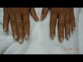 Video: Nail Fungus Laser Treatment-Before-After-Pictures