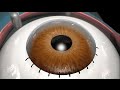 3D MEDICAL ANIMATION Cataract Surgery