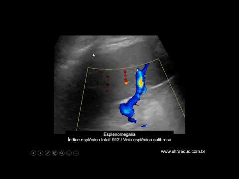 Ultrassonografia da Esteatose HepÃ¡tica