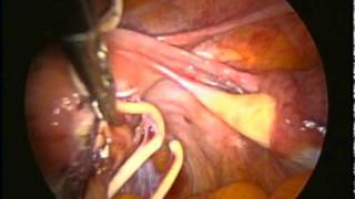 Retiro de dispositivo intrauterino en cavidad abdominal
