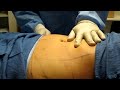Video: SmartLipo-Laser Liposuction Of Abdomen-Valley Aesthetics-Huntington Beach