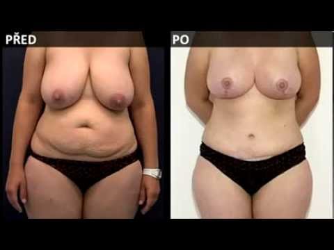 Modelace prsou a operace břicha