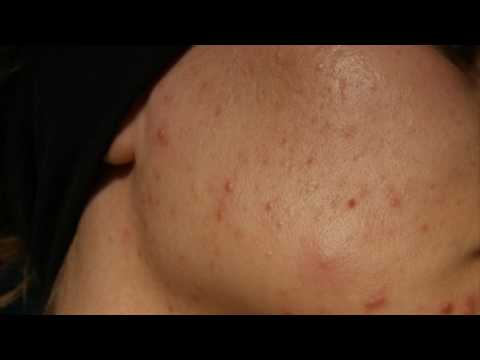 Подкожный прыщ как избавиться в домашних условиях Подкожный прыщ как избавиться в домашних условиях