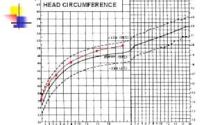 Microcephaly Growth Chart