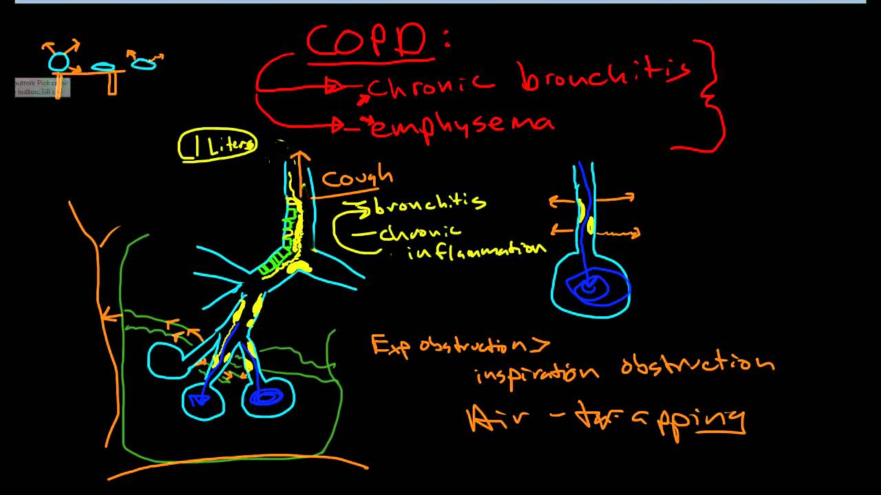 Chronic obstructive pulmonary diseases (COPD), comprised of pulmonary  emphysema, chronic. the lack of a clear understanding of the  pathophysiological mechanisms underlying the decrement of FEV1 ... Download  as PowerPoint Slide.