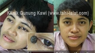 Photo Menghilangkan Tahi Lalat Andeng Andeng Tompel Biji Daging Secara Alami Tanpa Operasi