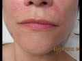 Video: Lips Enhancement-Juvedem-Restylane-Valley Aesthetics-Pankaj Karan,M.D.