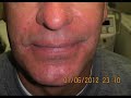 Video: Before and After Pictures-Rosacea-Rhinophyma
