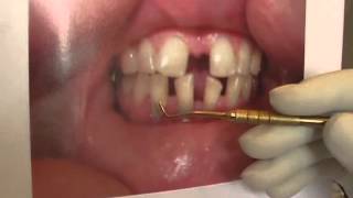 Зубные камни и профилактика пародонтита