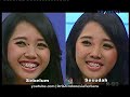 Picture Dr Oz Indonesia Menghilangkan Tahi Lalat Dengan Laser 7 September 2014