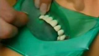 101 - Pose de la digue dentaire 