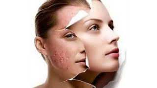 Como eliminar el acne y sus marcas (remedio casero)