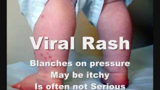 Blanching Rash