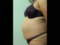 Video: SmartLipo-Abdomen-Love Handles