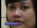 Image Pembuangan Tahi Lalat Wanita Hari Ini