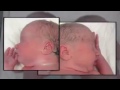 Des jumeaux se tenant la main à la naissance