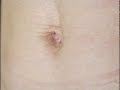 Video: Skin Tightening-Viora-Refit Program