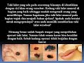 Photo 5 Cara Cepat Hilangkan Tahi Lalat Secara Alami