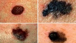 Photo 5 Cara Cepat Hilangkan Tahi Lalat Secara Alami