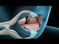 3D Medical Animation: Tonsillectomy Surgery