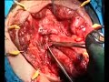 Picture How A Man S Penis Is Turned Into A Vagina