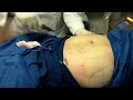 Video: Smartlipo-Laser Liposuction-Abdomen-Love Handles-Cynosure Smartlipo MPX