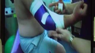 Elbow Hyperextension Taping