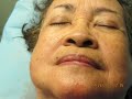Video: Liposuction-Neck-Double Chin-Jowl-Neckline
