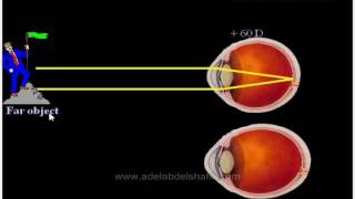 Errors of refraction for undergraduates : Introduction