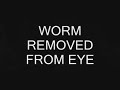 WORM LIKE CREATURE REMOVED FROM EYE