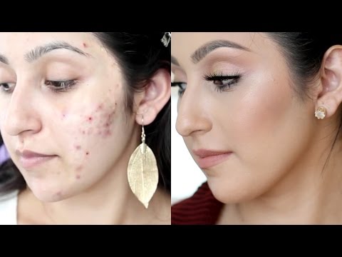 How I Got Rid Of My Acne + Faded My Scars - UCBc5MfHtsqVcT5E9A44LOvw