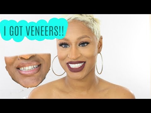 MY EXPERIENCE GETTING COMPOSITE VENEERS | WITH MEMPHIS DENTIST DR. PRICE - UCh3jn3YJpRd_usLKD_kwOaw