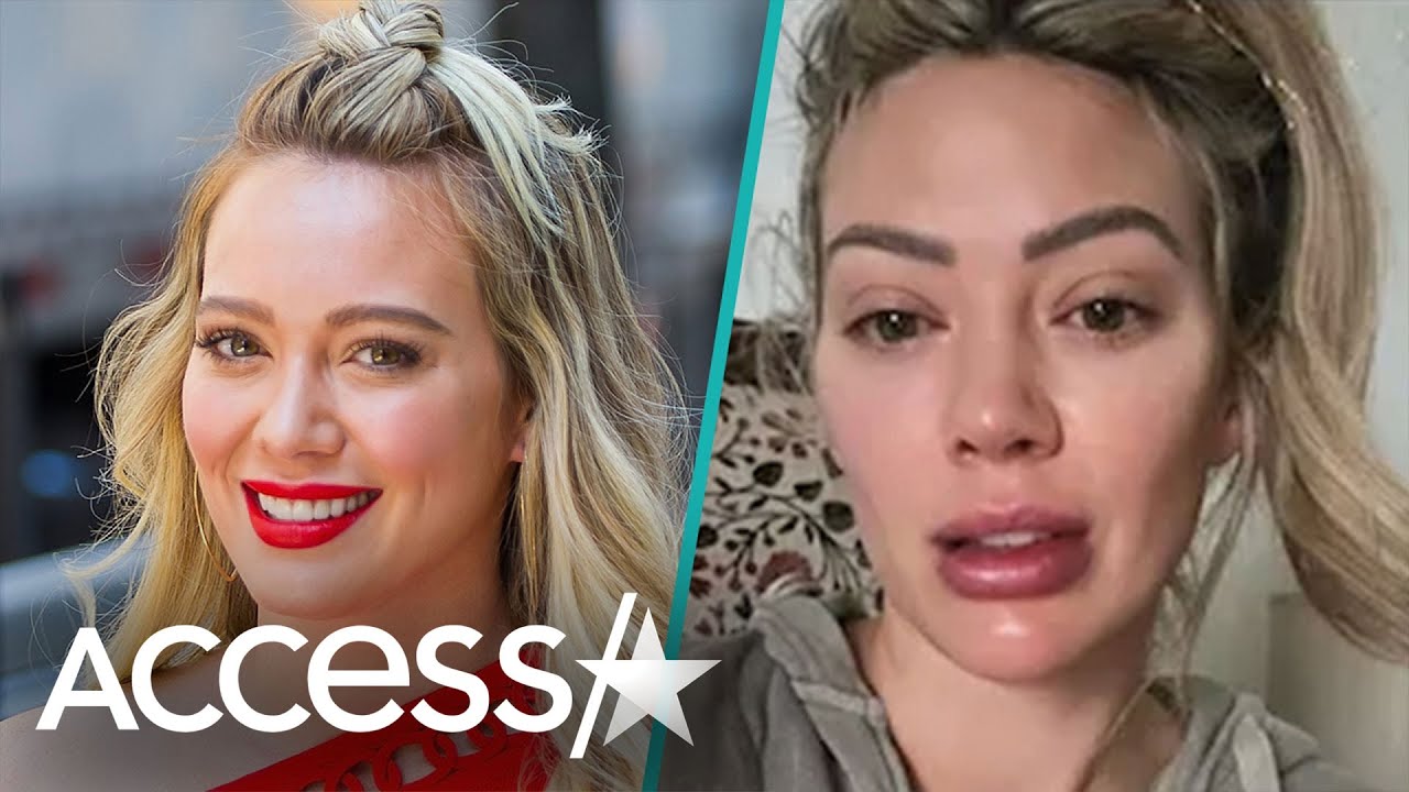 Hilary Duff Reveals Shocking Allergic Reaction To Scallops: I ‘Thought My Lip Might Explode’