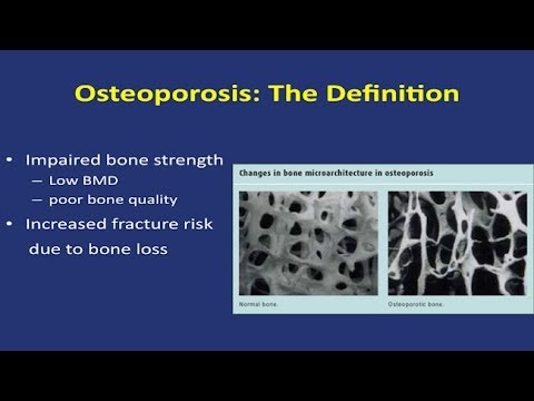 Save Your Bones: Osteoporosis Update 2014 - Research on Aging - UCh6KFtW4a4Ozr81GI1cxaBQ