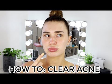 HOW TO CLEAR ACNE ON THE HOLIDAYS | Shani Grimmond - UCPG6A5tNaPfv2SRNW2beq5Q