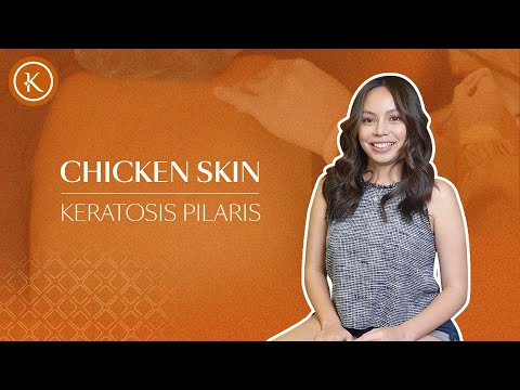 Treating Keratosis Pilaris | Chicken Skin