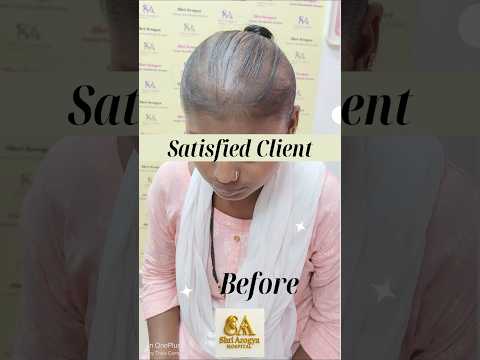 Severe Hair fall in a young lady.. responded beautifully with just the correction of Deficiencies...