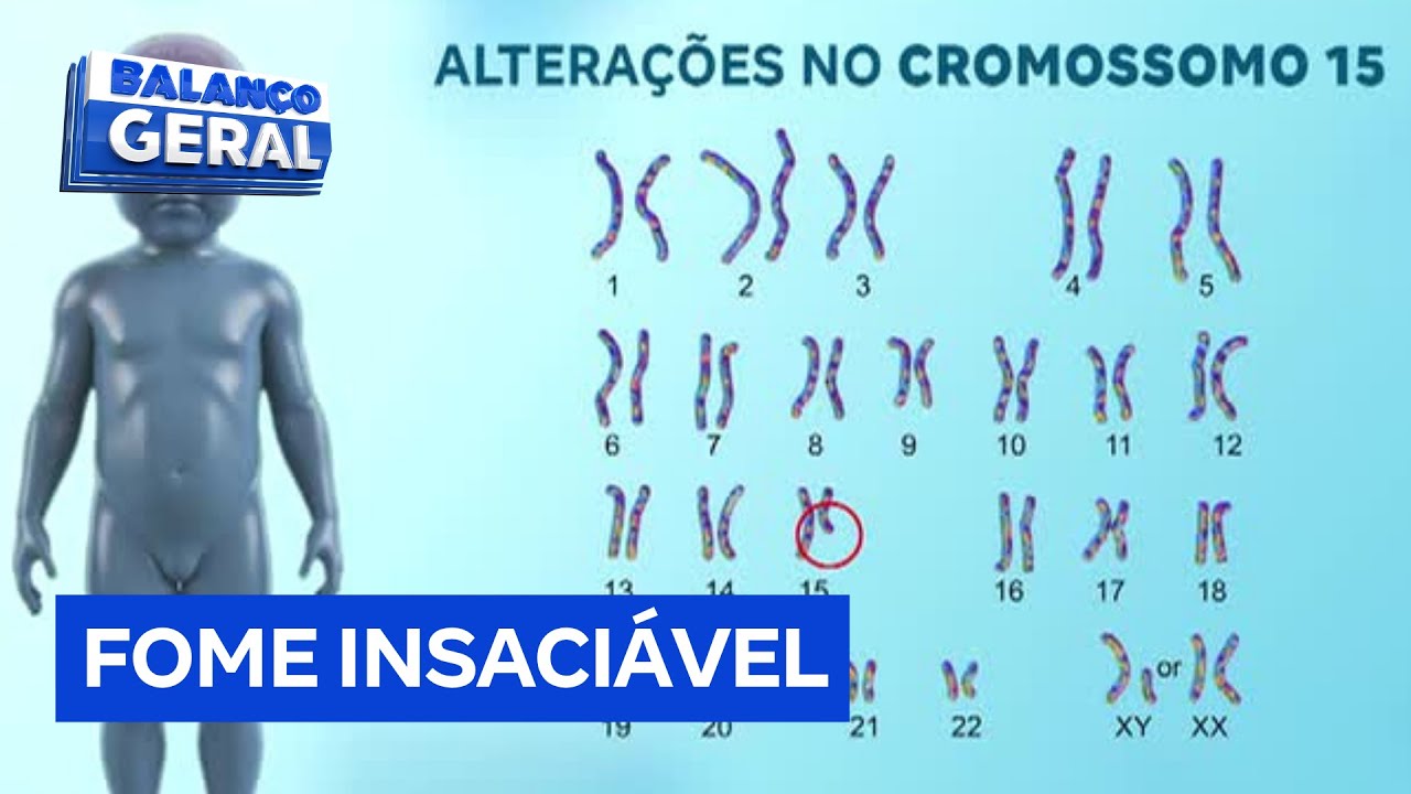 Fome insaciável síndrome genética rara que provoca fome constante pode causar morte precoce