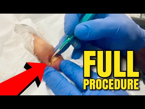 Extreme Ingrown Toenail Removal – Doctor's SATISFYING Procedure