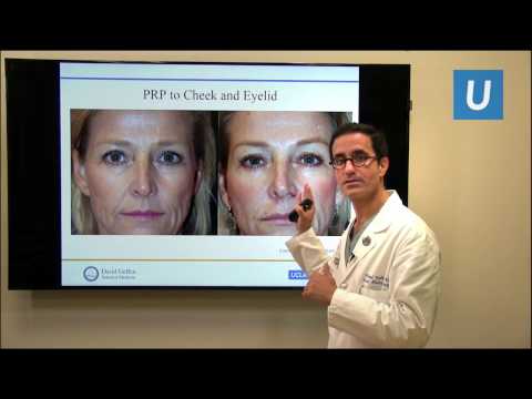 Platelet Rich Plasma (PRP) for Facial Rejuvenation and Hair Growth  | UCLA Heck and Neck Surgery - UCb_JYhqnSdEejiznUm3XNqQ