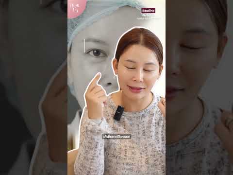 ชั้นตาหลบใน หนังตาห้อย ครั้งนี้ขอแก้ชั้นตาให้ตรงใจสักครั้ง!