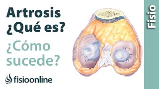 Artrosis - Cómo sucede y cuáles son sus causas