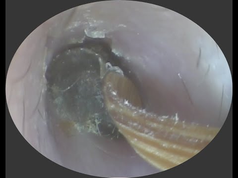 Vol.324【耳掃除】聞こえにくいのはこのせい？？前日YouTubeを見てご来店・・eariss