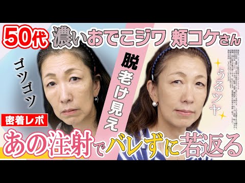 【50代から若返る方法】老け見えジワを根本的に改善する「脂肪注射」で感動の結果が待っていた【ヒアルロン酸じゃない若見え】湘南美容クリニック