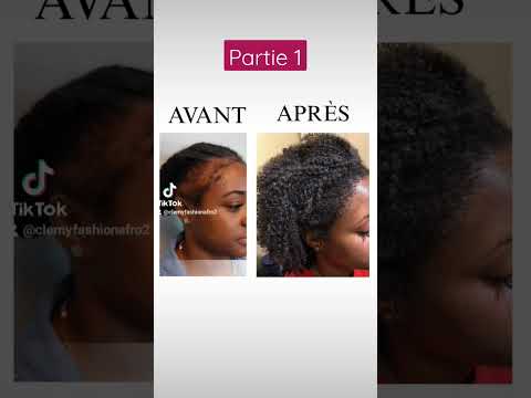 Solution contre Alopécie part 1